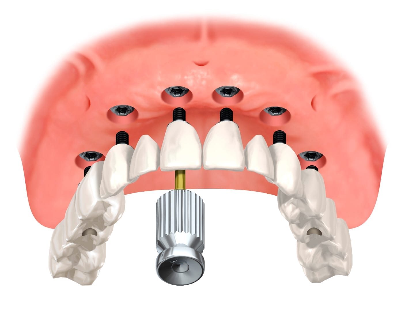 All on Six Dental Implants